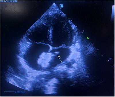 Case report: Early thrombosis in left atrial during transcatheter closure of ASD in a child with favorable outcome after use of GPIIb/IIIa receptor antagonist and heparin